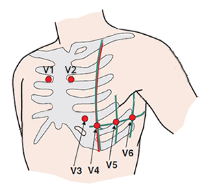 ECG leads V1, V2, 2nd intercostal space, Brugada syndrome