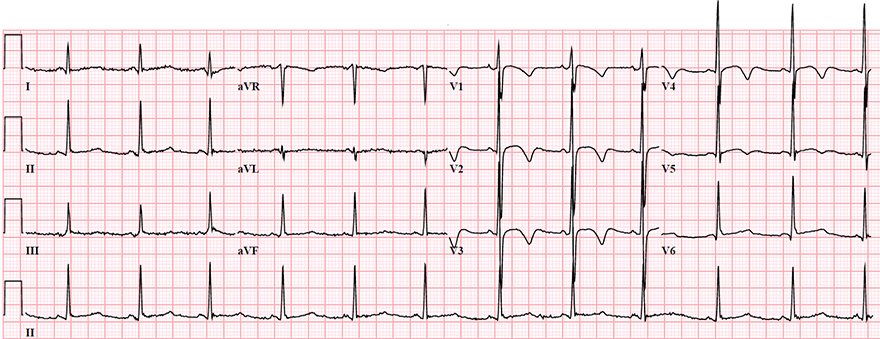 ECG T wave inversion in young woman with hyperventilation