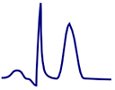 ECG tall, narrow, symmetrical, hyperacute, peaked T wave