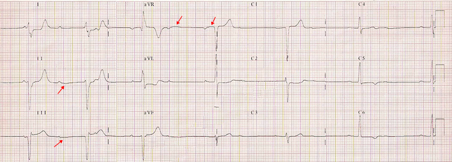 ECG negative Ta wave after P wave, second AV block Mobity (2:1)