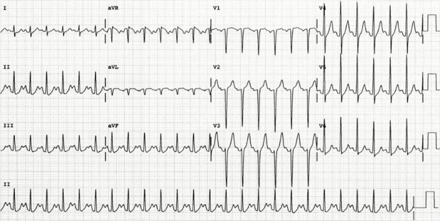 ECG atrial repolarization Ta wave and sinus tachycardia