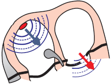 WPW syndrome, accessory pathway - Bundle of Kent and short PQ (PR)