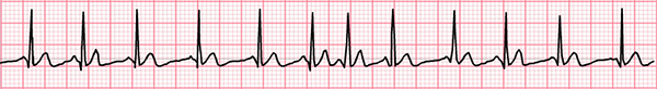 ECG Multifocal Atrial Tachycardia (MAT), Chaotic atrial tachycardia