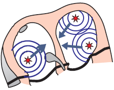multiple ectopic foci within the atria