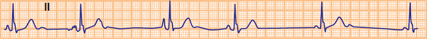 ECG Wandering Atrial Pacemaker, Multifocal Atrial Rhythm