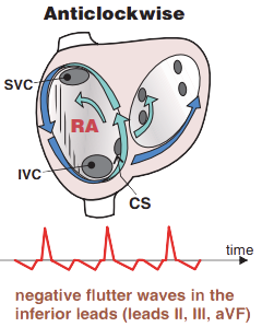 ECG Typical Anticlockwise atrial flutter, negative flutter waves in inferior leads II, III, aVF