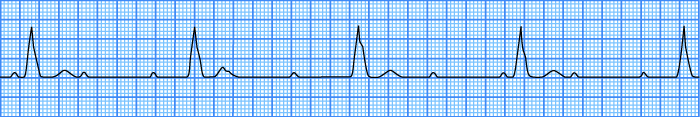 ECG 3rd degree AV block, AV dissociation, bilateral bundle block, ventricular escape rhythm
