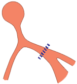 Heart conduction system incomplete left bundle branch block (iLBBB)