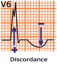 ECG LBBB, appropriate discordance, ST and T waves opposite in direction to QRS complex