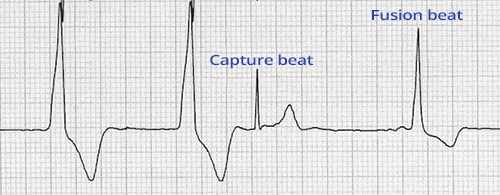 ECG ventricular couplet, fusion beat, capture beat