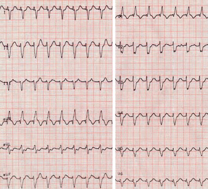 Fascicular tachycardia, Belhassen-type VT, verapamil-sensitive VT, Infrafascicular tachycardia, Idiopathic Fascicular Left Ventricular Tachycardia