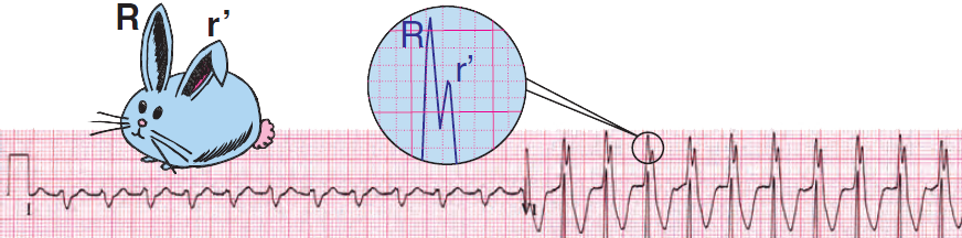 ECG ventricular tachycardia, RBBB-like pattern (V1). Taller left rabbit ear