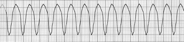 ECG Ventriculoatrial (VA) association, ventricular tachycardia
