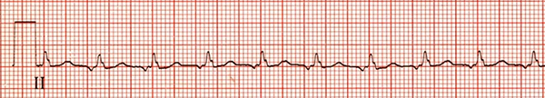 ECG Intra-atrial reentry/reentrant tachycardia (IART)
